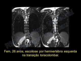 RM da Coluna Vertebral
