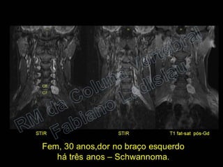 RM da Coluna Vertebral