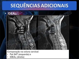 RM da Coluna Vertebral