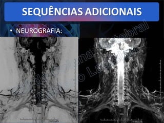 RM da Coluna Vertebral