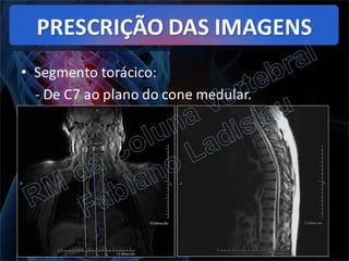 RM da Coluna Vertebral
