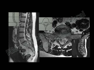 RM da Coluna Vertebral