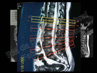 RM da Coluna Vertebral