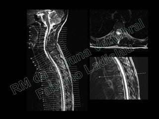RM da Coluna Vertebral