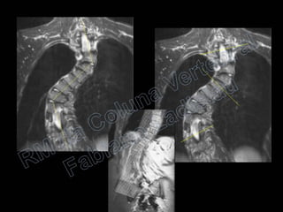 RM da Coluna Vertebral