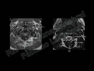 RM da Coluna Vertebral