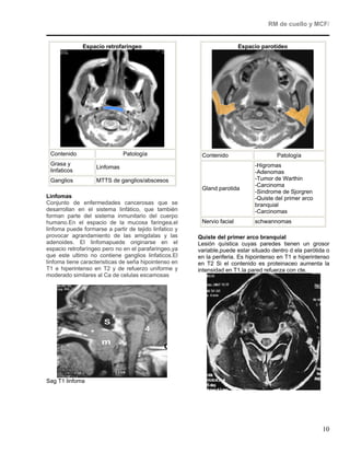 RM de cuello y MCF/


              Espacio retrofaringeo                                      Espacio parotídeo




 Contenido                     Patología                 Contenido                     Patología
 Grasa y                                                                      -Higromas
                    Linfomas
 linfaticos                                                                   -Adenomas
 Ganglios           MTTS de ganglios/abscesos                                 -Tumor de Warthin
                                                                              -Carcinoma
                                                         Gland parotida
                                                                              -Sindrome de Sjorgren
Linfomas                                                                      -Quiste del primer arco
Conjunto de enfermedades cancerosas que se                                    branquial
desarrollan en el sistema linfático, que también                              -Carcinomas
forman parte del sistema inmunitario del cuerpo
humano.En el espacio de la mucosa faringea,el            Nervio facial        schwannomas
linfoma puede formarse a partir de tejido linfatico y
provocar agrandamiento de las amigdalas y las           Quiste del primer arco branquial
adenoides. El linfomapuede originarse en el             Lesión quística cuyas paredes tienen un grosor
espacio retrofaríngeo pero no en el parafaringeo,ya     variable,puede estar situado dentro d ela parótida o
que este ultimo no contiene ganglios linfaticos.El      en la periferia. Es hipointenso en T1 e hiperintenso
linfoma tiene caracteristicas de seña hipointenso en    en T2 Si el contenido es proteinaceo aumenta la
T1 e hiperintenso en T2 y de refuerzo uniforme y        intensidad en T1.la pared refuerza con cte.
moderado similares al Ca de celulas escamosas




Sag T1 linfoma




                                                                                                         10
 