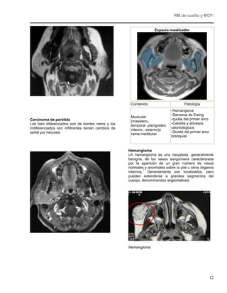 RM de cuello y MCF/


                                                                    Espacio masticador




                                                      Contenido                      Patología
                                                                              -Hemangiona
                                                                              -Sarcoma de Ewing
                                                      Muscular
Carcinoma de parótida                                                         -quiste del primer arco
                                                      (masetero,
Los bien diferenciados son de bordes netos y los                              -Celulitis y abcesos
                                                      temporal ,pterigoideo
indiferenciados son infiltrantes tienen cambios de                            odontológicos
                                                      interno , externo)y
señal por necrosis                                                            -Quiste del primer arco
                                                      rama madibular
                                                                              branquial


                                                     Hemangioma
                                                     Un hemangioma es una neoplasia, generalmente
                                                     benigna, de los vasos sanguíneos caracterizada
                                                     por la aparición de un gran número de vasos
                                                     normales y anormales sobre la piel u otros órganos
                                                     internos.1 Generalmente son localizados, pero
                                                     pueden extenderse a grandes segmentos del
                                                     cuerpo, denominandos angiomatosis




                                                     Hemangioma




                                                                                                        12
 