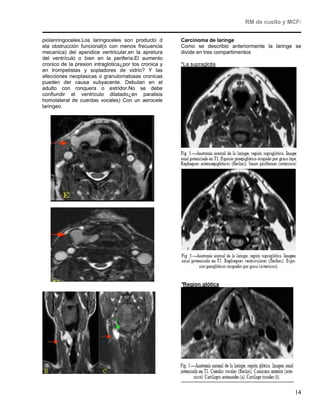 RM de cuello y MCF/


piolanringoceles.Los laringoceles son producto d       Carcinoma de laringe
ela obstrucción funcional(o con menos frecuencia       Como se describio anteriormente la laringe se
mecanica) del apendice ventricular,en la apretura      divide en tres compartimentos
del ventrículo o bien en la periferia.El aumento
cronico de la presion intraglotica¿por tos cronica y   *La supraglotis
en trompetistas y sopladores de vidrio? Y las
afecciones neoplasicas o granulomatosas cronicas
pueden der causa subyacente. Debutan en el
adulto con ronquera o estridor.No se debe
confiundir el ventriculo dilatado¿en paralisis
homolateral de cuerdas vocales) Con un aerocele
laringeo.




                                                       *Region glótica




                                                                                                 14
 
