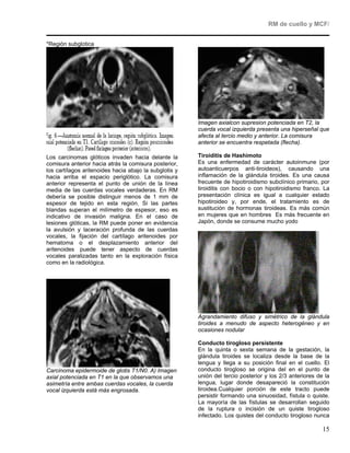 RM de cuello y MCF/


*Región subglotica




                                                        Imagen axialcon supresion potenciada en T2, la
                                                        cuerda vocal izquierda presenta una hiperseñal que
                                                        afecta al tercio medio y anterior. La comisura
                                                        anterior se encuentra respetada (flecha).

Los carcinomas glóticos invaden hacia delante la        Tiroiditis de Hashimoto
comisura anterior hacia atrás la comisura posterior,    Es una enfermedad de carácter autoinmune (por
los cartílagos aritenoides hacia abajo la subglotis y   autoanticuerpos anti-tiroideos), causando una
hacia arriba el espacio periglótico. La comisura        inflamación de la glándula tiroides. Es una causa
anterior representa el punto de unión de la línea       frecuente de hipotiroidismo subclínico primario, por
media de las cuerdas vocales verdaderas. En RM          tiroiditis con bocio o con hipotiroidismo franco. La
debería se posible distinguir menos de 1 mm de          presentación clínica es igual a cualquier estado
espesor de tejido en esta región. Si las partes         hipotiroideo y, por ende, el tratamiento es de
blandas superan el milímetro de espesor, eso es         sustitución de hormonas tiroideas. Es más común
indicativo de invasión maligna. En el caso de           en mujeres que en hombres Es más frecuente en
lesiones glóticas, la RM puede poner en evidencia       Japón, donde se consume mucho yodo
la avulsión y laceración profunda de las cuerdas
vocales, la fijación del cartílago aritenoides por
hematoma o el desplazamiento anterior del
aritenoides puede tener aspecto de cuerdas
vocales paralizadas tanto en la exploración física
como en la radiológica.




                                                        Agrandamiento difuso y simétrico de la glándula
                                                        tiroides a menudo de aspecto heterogéneo y en
                                                        ocasiones nodular

                                                        Conducto tirogloso persistente
                                                        En la quinta o sexta semana de la gestación, la
                                                        glándula tiroides se localiza desde la base de la
                                                        lengua y llega a su posición final en el cuello. El
Carcinoma epidermoide de glotis T1/N0. A) Imagen        conducto tirogloso se origina del en el punto de
axial potenciada en T1 en la que observamos una         unión del tercio posterior y los 2/3 anteriores de la
asimetría entre ambas cuerdas vocales, la cuerda        lengua, lugar donde desapareció la constitución
vocal izquierda está más engrosada.                     tiroidea.Cualquier porción de este tracto puede
                                                        persistir formando una sinuosidad, fístula o quiste.
                                                        La mayoría de las fístulas se desarrollan seguido
                                                        de la ruptura o incisión de un quiste tirogloso
                                                        infectado. Los quistes del conducto tirogloso nunca

                                                                                                          15
 