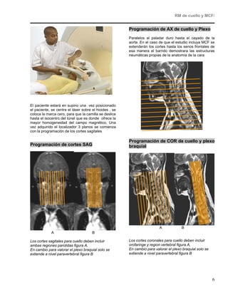 RM de cuello y MCF/


                                                        Programación de AX de cuello y Plexo
                                                        Paralelos al paladar duro hasta el cayado de la
                                                        aorta .En el caso de que el estudio incluya MCF se
                                                        extenderán los cortes hasta los senos frontales de
                                                        esa manera el barrido demostrara las estructuras
                                                        neumáticas propias de la anatomía de la cara




El paciente estará en supino una vez posicionado
el paciente, se centra el láser sobre el hioides , se
coloca la marca cero, para que la camilla se deslice
hasta el isocentro del túnel que es donde ofrece la
mayor homogeneidad del campo magnético, Una
vez adquirido el localizador 3 planos se comienza
con la programación de los cortes sagitales

                                                        Programación de COR de cuello y plexo
Programación de cortes SAG                              braquial




                                                                          A            B
             A                        B

Los cortes sagitales para cuello deben incluir          Los cortes coronales para cuello deben incluir
ambas regiones parotidas figura A,                      orofaringe y region vertebral figura A,
En cambio para valorar el plexo braquial solo se        En cambio para valorar el plexo braquial solo se
extiende a nivel paravertebral figura B                 extiende a nivel paravertebral figura B




                                                                                                           6
 