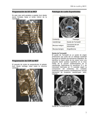 RM de cuello y MCF/


Programación de AX de MCF                          Patología de cuello Suprahioidea
En este caso será paralelos a paladar duro desde
senos frontales hasta el borde inferior de la                  Espacio mucoso faríngeo
mandíbula




                                                   Contenido                      Patología
                                                   nasofaringe          Quiste de Tornwaldt
                                                                        Carcinoma de cel
                                                   Mucosa maligno
                                                                        escamosas
                                                   Mucosa benigno       Angiofibroma

                                                   Quiste de Tornwaldt
                                                   El quiste de Tornwaldt es un quiste de origen
                                                   embrionario que suele ser un hallazgo incidental
                                                   frecuente en estudios de resonancia magnética. Se
                                                   identifica la mayor parte de las veces como una
Programación de COR de MCF
                                                   pequeña lesión quística superficial en la línea
                                                   media de la porción posterosuperior de la
El paquete de cortes se perpendicular al paladar
                                                   nasofaringe, hiperintensa en secuencia T2 y de
duro desde cartílago nasal hasta la columna
                                                   intensidad intermedia en T1 (variable según la
vertebral
                                                   composición del contenido). En contadas
                                                   ocasiones puede producir manifestaciones clínicas
                                                   (sensación de ocupación nasofaríngea, dolor,
                                                   halitosis.




                                                   Quiste de Tornwaldt axial T2



                                                                                                  7
 
