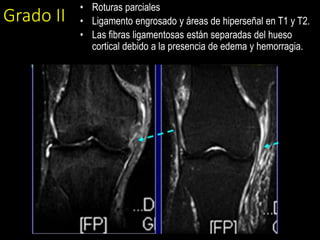 Grado II
• Roturas parciales
• Ligamento engrosado y áreas de hiperseñal en T1 y T2.
• Las fibras ligamentosas están separadas del hueso
cortical debido a la presencia de edema y hemorragia.
 