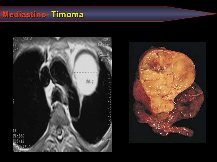 RM de TORAX vision patologica para tecnicos