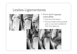 Lesões Ligamentares
                 Rotura Aguda, Ligamento
                  Calcaneofibular
                   Espess...