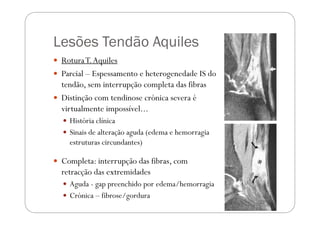 Lesões Tendão Aquiles
 Rotura T. Aquiles
 Parcial – Espessamento e heterogenedade IS do
  tendão, sem interrupção comple...
