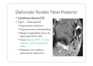 Disfunção Tendão Tibial Posterior
 Classificação Roturas TTP
 Tipo I – rotura parcial
   Espessamento fusiforme
   Deg...