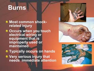 Burns
Most common shock-
related injury
Occurs when you touch
electrical wiring or
equipment that is
improperly used or
maintained
Typically occurs on hands
Very serious injury that
needs immediate attention
 
