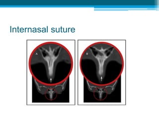 Tooth and tissue borne
Derichsweiler type Hass type
Wire tags Thick SS wire -
1.2mm
Image Source: Bhalajhi SI. Orthodontics: At The Art and Science (5th Ed)
 