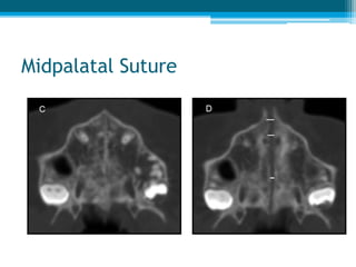 RAPID MAXILLARY EXPANSION
1. What are the effects of RME on facial sutures
and bone?
2. How do RME affect the airway?
3. What are the dental changes caused by RME?
 