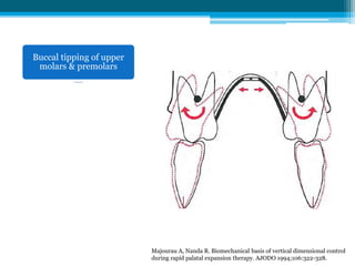 Mid-palatal suture: Mean expansion
Posterior region
= 1.6 -4.33 mm
= 22%–53% screw expansion
Anterior region
= 1.52 to 4.33 mm
= 20%–53% screw expansion
Mid-palatal suture opening = 20%–50% screw opening
 