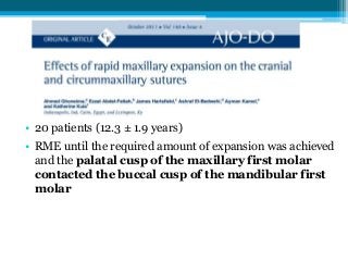 • 20 patients (12.3 ± 1.9 years)
• RME until the required amount of expansion was achieved
and the palatal cusp of the maxillary first molar
contacted the buccal cusp of the mandibular first
molar
 