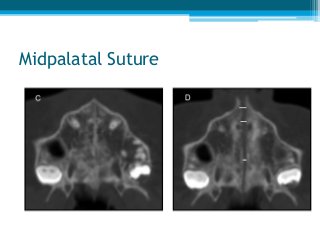 Midpalatal Suture
 