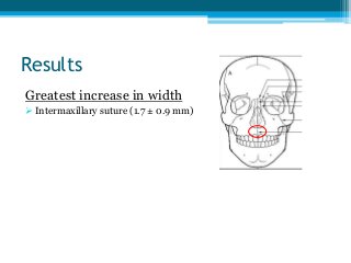 Results
Greatest increase in width
 Intermaxillary suture (1.7 ± 0.9 mm)
 