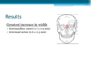 Results
Greatest increase in width
 Intermaxillary suture (1.7 ± 0.9 mm)
 Internasal suture (0.6 ± 0.3 mm)
 