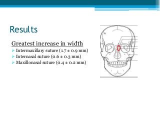 Results
Greatest increase in width
 Intermaxillary suture (1.7 ± 0.9 mm)
 Internasal suture (0.6 ± 0.3 mm)
 Maxillonasal suture (0.4 ± 0.2 mm)
 