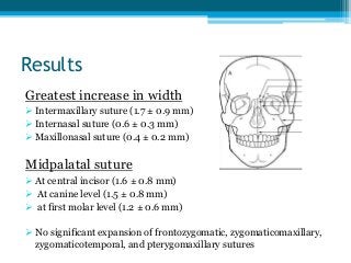 Results
Greatest increase in width
 Intermaxillary suture (1.7 ± 0.9 mm)
 Internasal suture (0.6 ± 0.3 mm)
 Maxillonasal suture (0.4 ± 0.2 mm)
Midpalatal suture
 At central incisor (1.6 ± 0.8 mm)
 At canine level (1.5 ± 0.8 mm)
 at first molar level (1.2 ± 0.6 mm)
 No significant expansion of frontozygomatic, zygomaticomaxillary,
zygomaticotemporal, and pterygomaxillary sutures
 