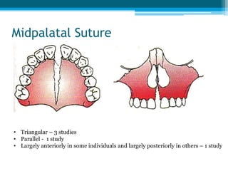 Indications for RME
• Posterior crossbites
• Class III malocclusions
• Cleft palate patients with collapsed maxillary
arch
• Adjunct to facemask therapy
 