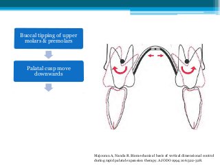 Majourau A, Nanda R.
Biomechanical basis of
vertical dimensional
control during rapid palatal
expansion therapy. AmJ
Orthod
Dentofacial Orthop
1994;106:322-328.
Buccal tipping of upper
molars & premolars
Palatal cusp move
downwards
Premature contact with
lower teeth
Clockwise rotation of
mandible
Majourau A, Nanda R. Biomechanical basis of vertical dimensional control
during rapid palatal expansion therapy. AJODO 1994;106:322-328.
Majourau A, Nanda R.
Biomechanical basis of
vertical dimensional
control during rapid palatal
expansion therapy. AmJ
Orthod
Dentofacial Orthop
1994;106:322-328.
 
