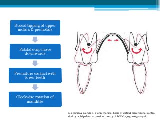 Majourau A, Nanda R.
Biomechanical basis of
vertical dimensional
control during rapid palatal
expansion therapy. AmJ
Orthod
Dentofacial Orthop
1994;106:322-328.
Buccal tipping of upper
molars & premolars
Palatal cusp move
downwards
Premature contact with
lower teeth
Clockwise rotation of
mandible
Majourau A, Nanda R. Biomechanical basis of vertical dimensional control
during rapid palatal expansion therapy. AJODO 1994;106:322-328.
 