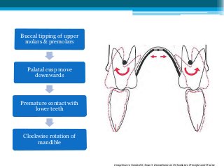 Buccal tipping of upper
molars & premolars
Palatal cusp move
downwards
Premature contact with
lower teeth
Clockwise rotation of
mandible
Image Source: Nanda RS, Tosun Y. Biomechanics in Orthodontics: Principles and Practice
 
