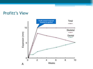 Tooth borne
lsaacson type Hyrax type
Spring loaded screw-
Minne Expander
 