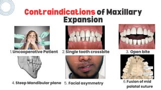 Rapid maxillary expansion and slow maxillary expansion | PDF