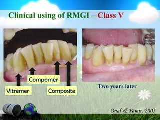 RMGI - RestorativeFor Fuji II LC, 10% polyacrylic acid application is able to create micro-mechanical retention.(Sidhu, 1999)For Vitremer, due to high amounts of HEMA, hydrolitic degradation of Vitremer-dentin bonds might be expected to occur. (Fritz et al., 1996)In term of bond durability, sealing ability, Fuji II              LC is better than Vitremer. (Fagundeset al., 2009)