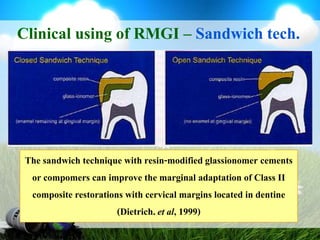 Clinical using of RMGI – Class VSurvival rate3-step etch and rinseGlass ionomer2-step etch and rinsePuemans et al., 2005