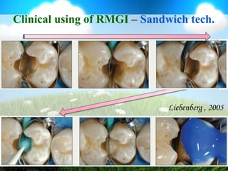 Clinical using of RMGI – Class VFailure ratePuemans et al., 2005