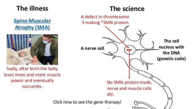 The illness
Spino-Muscular
Atrophy (SMA)
A defect in chromosome
5 making *SMN protein
Sadly, after birth the baby
loses more and more muscle
power and eventually
succumbs.
A nerve cell
The science
Click now to see the gene therapy!
No SMN protein made,
nerve and muscle cells
die.
The cell
nucleus with
the DNA
(genetic code)
 