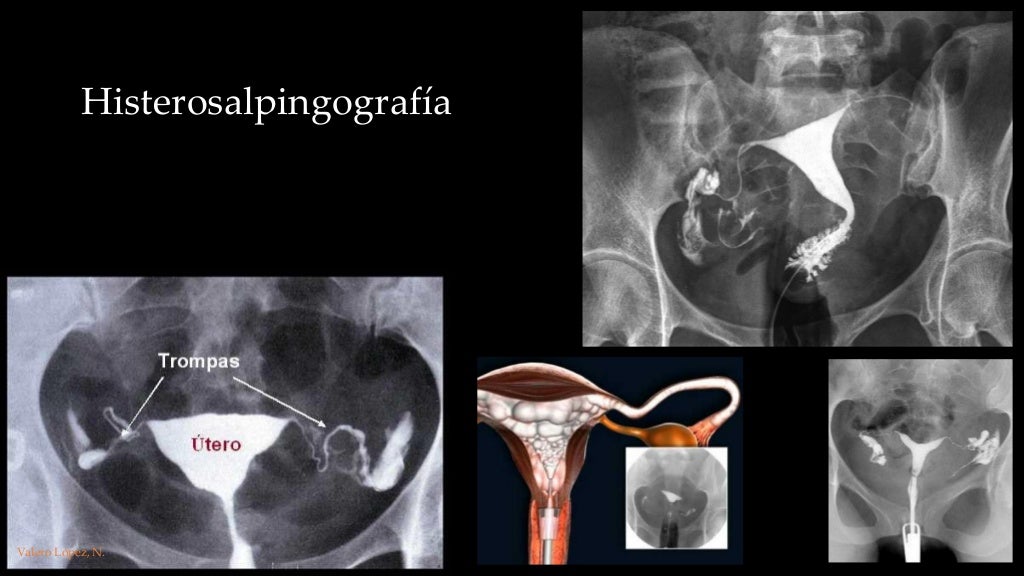 Anatomía por la imagen. Rm, histerosalpingografía. genitales mujer.