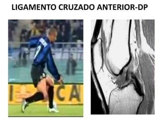 LIGAMENTO CRUZADO ANTERIOR-DP
 