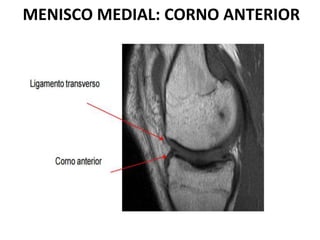 MENISCO MEDIAL: CORNO ANTERIOR
 