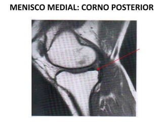 MENISCO MEDIAL: CORNO POSTERIOR
 