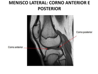 MENISCO LATERAL: CORNO ANTERIOR E
POSTERIOR
 
