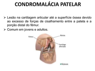 CONDROMALÁCIA PATELAR
 Lesão na cartilagem articular até a superfície óssea devido
ao excesso de forças de cisalhamento entre a patela e a
porção distal do fêmur.
 Comum em jovens e adultos.
 