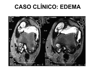 CASO CLÍNICO: EDEMA
 