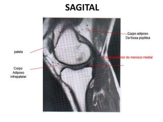SAGITAL
 