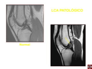 LCA PATOLÓGICO
Normal
 